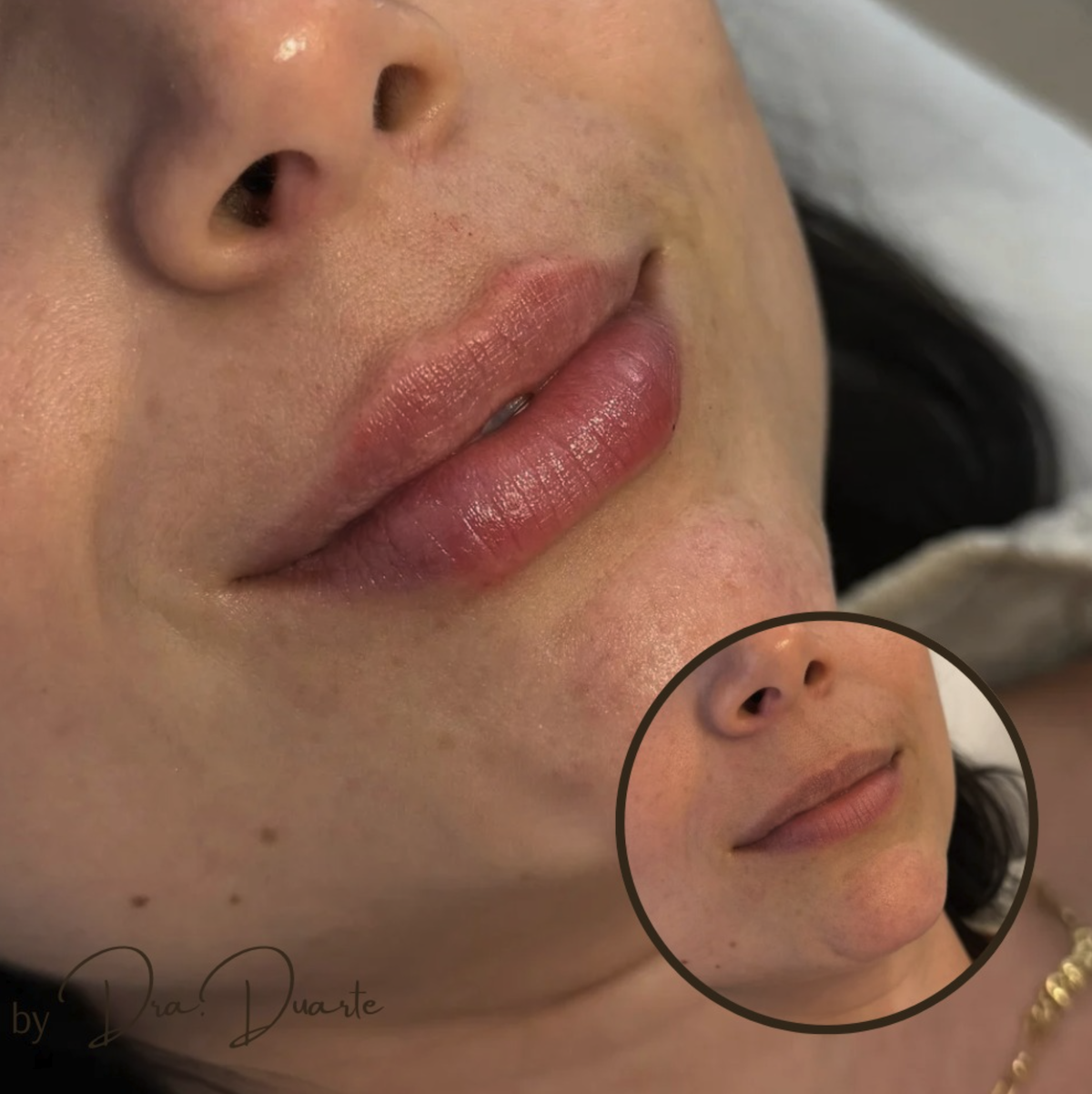 Resultados antes y después de tratamiento de armonización facial con rellenos dérmicos